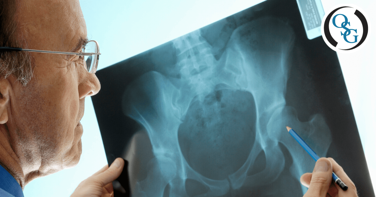 5 Signs It's Time to Consider a Hip Replacement: Ortho 1 Medical Group:  Orthopedic Specialists