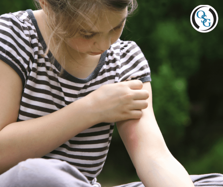 How to Soothe Itchy Mosquito Bites Orthopaedic Specialty Group